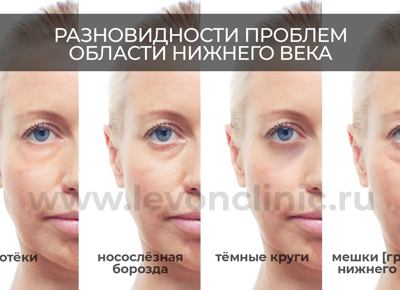 Убираем мешки и синяки под глазами в Фотошопе